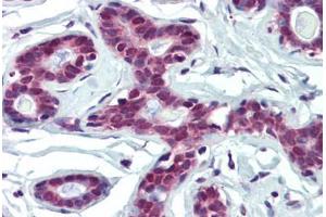 Human Breast (formalin-fixed, paraffin-embedded) stained with FUBP1 antibody ABIN462199 followed by biotinylated goat anti-rabbit IgG secondary antibody ABIN481713, alkaline phosphatase-streptavidin and chromogen. (FUBP1 antibody  (AA 540-589))