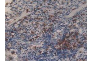 IHC-P analysis of Human Lung Cancer Tissue, with DAB staining. (MMP 9 antibody  (AA 213-399))