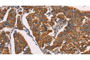 Immunohistochemistry of paraffin-embedded Human breast cancer using SPR Polyclonal Antibody at dilution of 1:40 (SPR antibody)