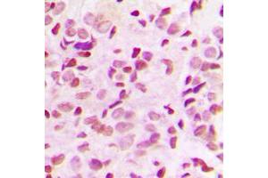 Immunohistochemical analysis of NF-kappaB p65 (pT435) staining in human breast cancer formalin fixed paraffin embedded tissue section.