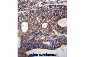 UQCRB Antibody (Center) immunohistochemistry analysis in formalin fixed and paraffin embedded human colon carcinoma followed by peroxidase conjugation of the secondary antibody and DAB staining. (UQCRB antibody  (Middle Region))