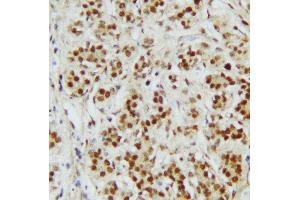 Anti-CTBP2 antibody, IHC(P) IHC(P): Human Mammary Cancer Tissue (CTBP2 antibody  (C-Term))