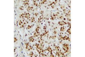 Anti-CTBP2 antibody, IHC(P) IHC(P): Human Mammary Cancer Tissue