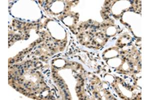 The image on the left is immunohistochemistry of paraffin-embedded Human thyroid cancer tissue using ABIN7128063(UCHL3 Antibody) at dilution 1/25, on the right is treated with fusion protein. (UCHL3 antibody)