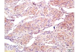 Formalin-fixed and paraffin embedded human cervical carcinoma labeled with Anti-HCCR1/BRI3BP Polyclonal Antibody, Unconjugated (ABIN668170) at 1:200 followed by conjugation to the secondary antibody and DAB staining