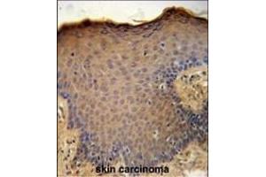 CXCL9 Antibody (C-term) (ABIN651314 and ABIN2840183) immunohistochemistry analysis in formalin fixed and paraffin embedded human skin carcinoma followed by peroxidase conjugation of the secondary antibody and DAB staining. (CXCL9 antibody  (C-Term))