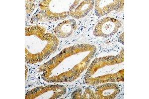 Immunohistochemical analysis of PPOX staining in human colon cancer formalin fixed paraffin embedded tissue section. (PPOX antibody)