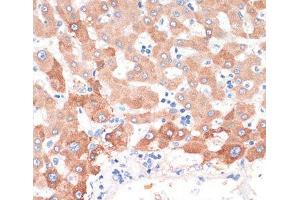 Immunohistochemistry of paraffin-embedded Human liver cancer using CHAT Polyclonal Antibody at dilution of 1:200 (40x lens). (Choline Acetyltransferase antibody)