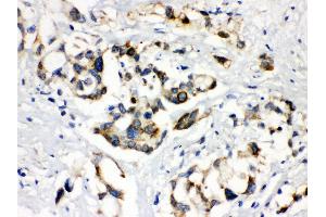 Anti- ABCB11 Picoband antibody, IHC(P) IHC(P): Human Liver Cancer Tissue (ABCB11 antibody  (C-Term))