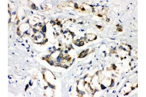Anti- ABCB11 Picoband antibody, IHC(P) IHC(P): Human Liver Cancer Tissue
