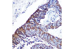 Immunohistochemistry of paraffin-embedded Human colon carcinoma using DOK4 Rabbit pAb (ABIN3020721, ABIN3020722, ABIN3020723 and ABIN6213691) at dilution of 1:100 (40x lens). (DOK4 antibody  (AA 240-326))