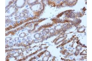 IHC testing of FFPE human thyroid carcinoma with TSH Receptor antibody (clone SPM222). (TSHR, B Chain antibody)