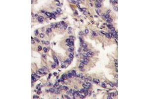 Formalin-fixed and paraffin-embedded human lung carcinoma tissue reacted with VEGF3 Antibody (Center ) (ABIN388784 and ABIN2839116) , which was peroxidase-conjugated to the secondary antibody, followed by DAB staining. (VEGFC antibody  (AA 248-277))