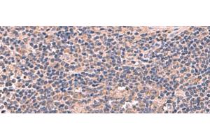 Immunohistochemistry of paraffin-embedded Human cervical cancer tissue using MAGEC2 Polyclonal Antibody at dilution of 1:60(x200) (MAGEC2 antibody)