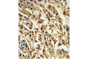 Formalin-fixed and paraffin-embedded human breast carcinoma reacted with SREBF1 Antibody (Center), which was peroxidase-conjugated to the secondary antibody, followed by DAB staining. (SREBF1 antibody  (AA 349-378))