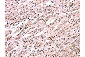 The image on the left is immunohistochemistry of paraffin-embedded Human prostate cancer tissue using ABIN7190608(EXTL1 Antibody) at dilution 1/20, on the right is treated with synthetic peptide. (EXTL1 antibody)