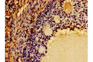 Immunohistochemistry of paraffin-embedded human ovarian cancer using ABIN7149290 at dilution of 1:100 (CD131 antibody  (AA 492-710))