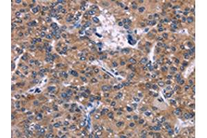 The image on the left is immunohistochemistry of paraffin-embedded Human liver cancer tissue using ABIN7192381(SKI Antibody) at dilution 1/40, on the right is treated with synthetic peptide. (SKI antibody)