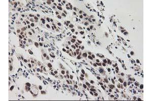 Immunohistochemical staining of paraffin-embedded Carcinoma of Human lung tissue using anti-GTF2F1 mouse monoclonal antibody. (GTF2F1 antibody)
