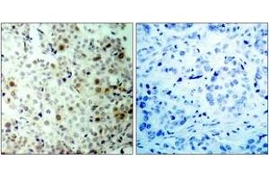 Immunohistochemistry analysis of paraffin-embedded human breast carcinoma, using CDC2 (Phospho-Thr161) Antibody. (CDK1 antibody  (pThr161))