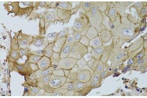 Immunohistochemistry of paraffin-embedded Human breast cancer using GGT1 Polyclonal Antibody at dilution of 1:100 (40x lens). (GGT1 antibody)