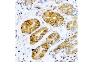 Immunohistochemical analysis of TMPRSS2 staining in human stomach cancer formalin fixed paraffin embedded tissue section. (TMPRSS2 antibody)