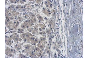 IHC-P Image Immunohistochemical analysis of paraffin-embedded human hepatoma, using PME-1, antibody at 1:500 dilution. (PPME1 antibody)