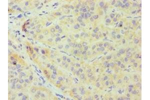 Immunohistochemistry of paraffin-embedded human liver cancer using ABIN7148700 at dilution of 1:100 (CRY1 antibody  (AA 507-586))