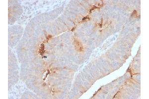 Formalin-fixed, paraffin-embedded human Colon Carcinoma stained with Serum Amyloid A Recombinant Rabbit Monoclonal Antibody (SAA/2868R). (Recombinant SAA antibody)