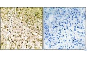 Immunohistochemistry analysis of paraffin-embedded human breast carcinoma, using DNA Polymerase thet Antibody. (POLQ antibody  (AA 181-230))