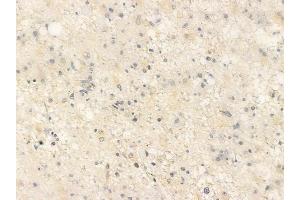 ABIN6261425 and ABIN6266808 at 1/100 staining human astrocytoma by IHC-P.