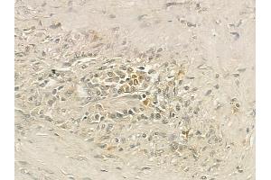 ABIN6262686 and ABIN6276788 at 1/100 staining human lung squamous cell carcinoma by IHC-P.