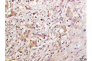 Formalin-fixed and paraffin embedded human gastric carcinoma tissue labeled with Anti-CD34 Polyclonal Antibody, Unconjugated (ABIN676898) at 1:200 followed by conjugation to the secondary antibody and DAB staining (CD34 antibody  (AA 201-300))