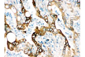 FASN was detected in paraffin-embedded sections of human intestinal cancer tissues using rabbit anti- FASN Antigen Affinity purified polyclonal antibody at 1 μg/mL. (Fatty Acid Synthase antibody  (AA 1-226))