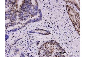 Immunoperoxidase of monoclonal antibody to WT1 on formalin-fixed paraffin-embedded human colon cancer. (WT1 antibody  (AA 349-439))