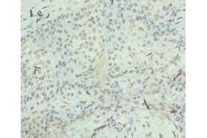Immunohistochemistry of paraffin-embedded human breast cancer using ABIN7156933 at dilution of 1:100 (IL-8 antibody  (AA 23-99))