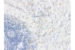 ABIN6256190 and ABIN6267542 at 1/100 staining human colon carcinoma by IHC-P.