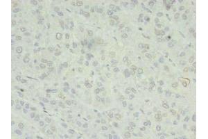 Immunohistochemistry of paraffin-embedded human liver cancer using ABIN7176040 at dilution of 1:100 (ZC3H7A antibody  (AA 1-167))
