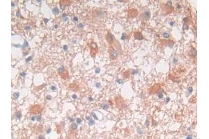 DAB staining on IHC-P; Samples: Human Glioma Tissue (FRK antibody  (AA 234-491))