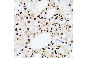 Immunohistochemistry of paraffin-embedded human liver cancer using hnRNP Q/SYNCRIP /SYNCRIP Rabbit mAb (ABIN7270673) at dilution of 1:100 (40x lens). (SYNCRIP antibody)