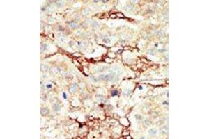 Formalin-fixed and paraffin-embedded human cancer tissue reacted with the primary antibody, which was peroxidase-conjugated to the secondary antibody, followed by DAB staining. (FGFR3 antibody  (C-Term))
