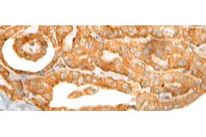 Immunohistochemistry of paraffin-embedded Human thyroid cancer tissue using CEP72 Polyclonal Antibody at dilution of 1:40(x200) (CEP72 antibody)