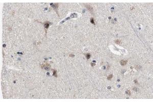 ABIN6272383 at 1/100 staining Human brain cancer tissue by IHC-P. (PDE4B/C/D antibody)