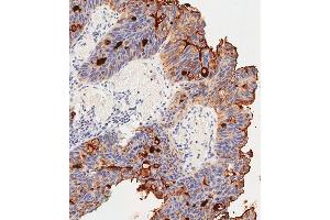 Immunohistochemical analysis of paraffin-embedded Human colon carcinoma tissue using (ABIN391544 and ABIN2841493) performed on the Leica® BOND RXm. (CEACAM5 antibody  (N-Term))