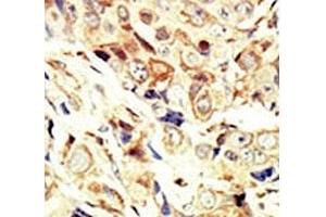 IHC analysis of FFPE human breast carcinoma tissue stained with the IGF1R antibody (IGF1R antibody  (AA 19-51))