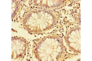 Immunohistochemistry of paraffin-embedded human colon cancer using ABIN7150132 at dilution of 1:100 (DDIT3 antibody  (AA 1-169))