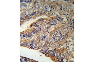 IL1RN Antibody (Center) (R) IHC analysis in formalin fixed and paraffin embedded human Colon carcinoma followed by peroxidase conjugation of the secondary antibody and DAB staining. (IL1RN antibody  (AA 100-129))