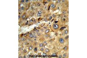 Formalin-fixed and paraffin-embedded human hepatocarcinoma reacted with TAT Antibody (Center), which was peroxidase-conjugated to the secondary antibody, followed by DAB staining. (TAT antibody  (Middle Region))