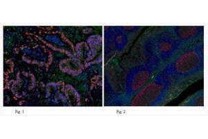 Immunofluorescent analysis of human colon adenocarcinomat tissue (Fig.