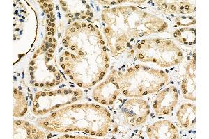 ABIN6260268 and ABIN6276437 at 1/100 staining Human kidney cancer and adjacent normal tissues by IHC-P.